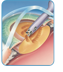 Cataract Surgery Fredericksburg & Culpeper, VA