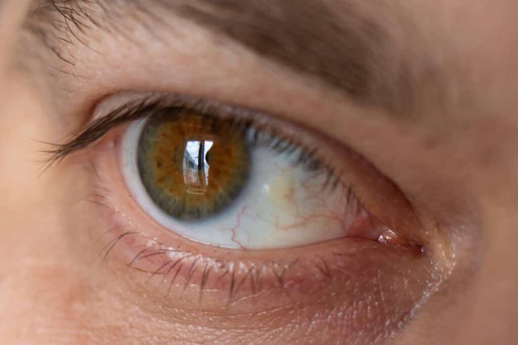 Close-up photo of pinguecula on a patient's eye.