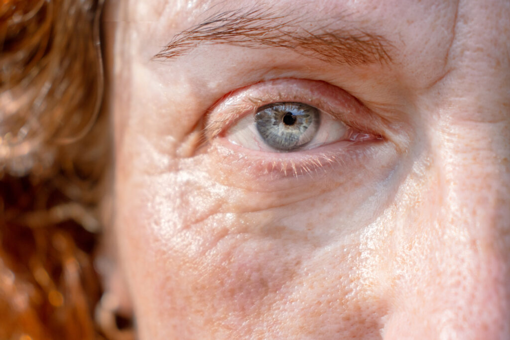 Close-up of an eye with upper eyelid skin, illustrating droopy eyelids that may affect vision.